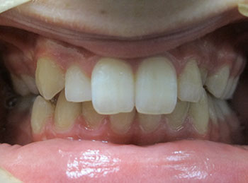 This patient had braces and growth modification therapy to correct a deep overbite and crooked teeth.