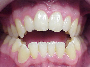 This patient had braces and growth modification therapy to correct bite issues, including a deep overbite, crooked teeth, and a lower jaw that was too far back.