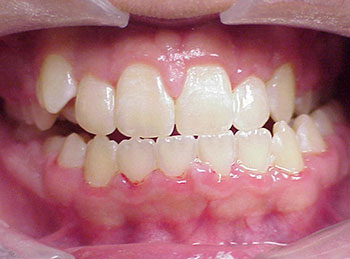 This patient had braces and jaw surgery to correct the bite, spacing and crooked teeth.