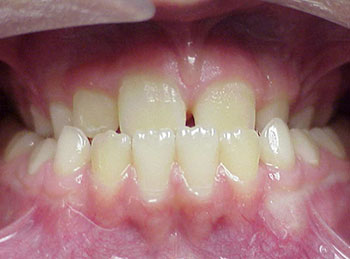This patient with an underbite was treated without a jaw operation and with orthodontics only.