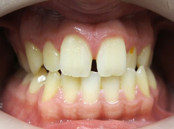 This patient had braces to correct the crossbites, spacing and crooked teeth.