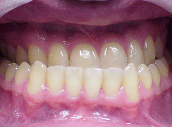 This patient had a severe underbite and was treated with braces and jaw surgery.