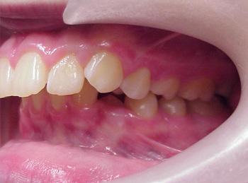 This patient had severe overjet and a deep overbite and was treated with upper and lower braces and growth modification.