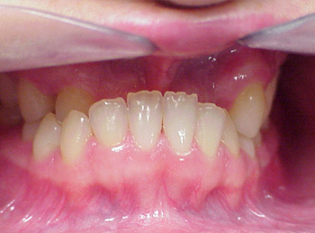 This patient had a severe underbite and was treated with braces only and did not require jaw surgery.