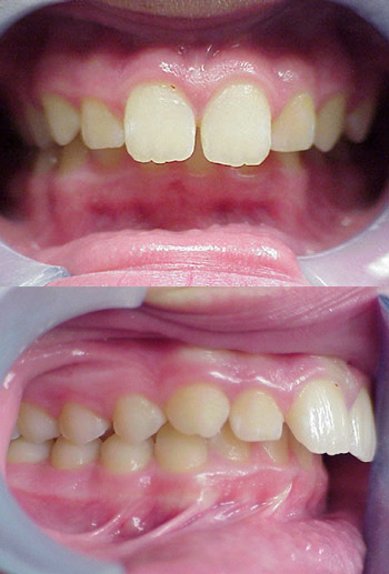 This patient had braces on the top and bottom teeth and growth modification therapy to address the severe overjet and crooked teeth.