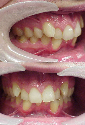 This patient had severe crowding and required braces to straighten the teeth.